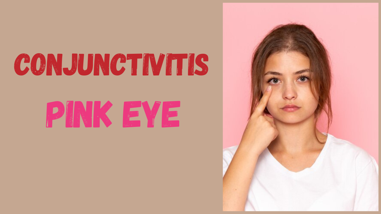 Conjunctivitis